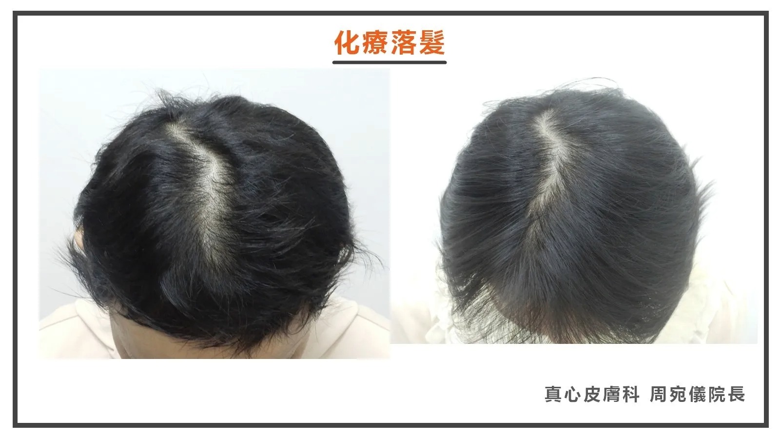化療落髮
