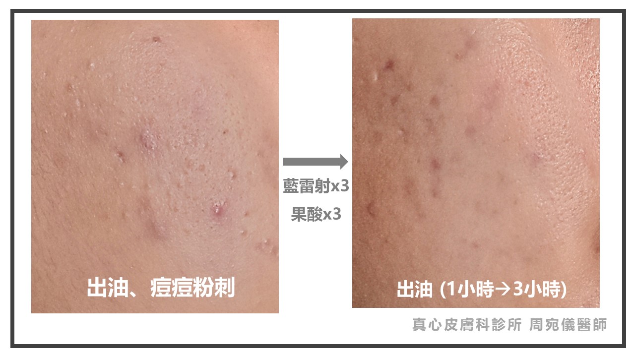 藍雷射效果