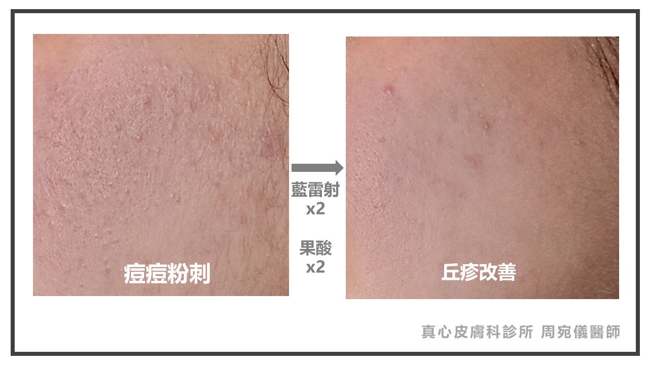 藍雷射痘痘
