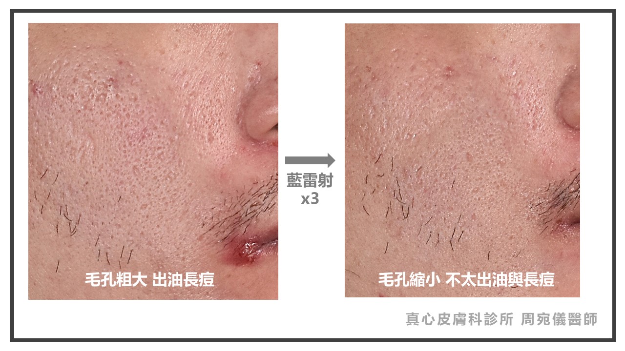 藍雷射效果