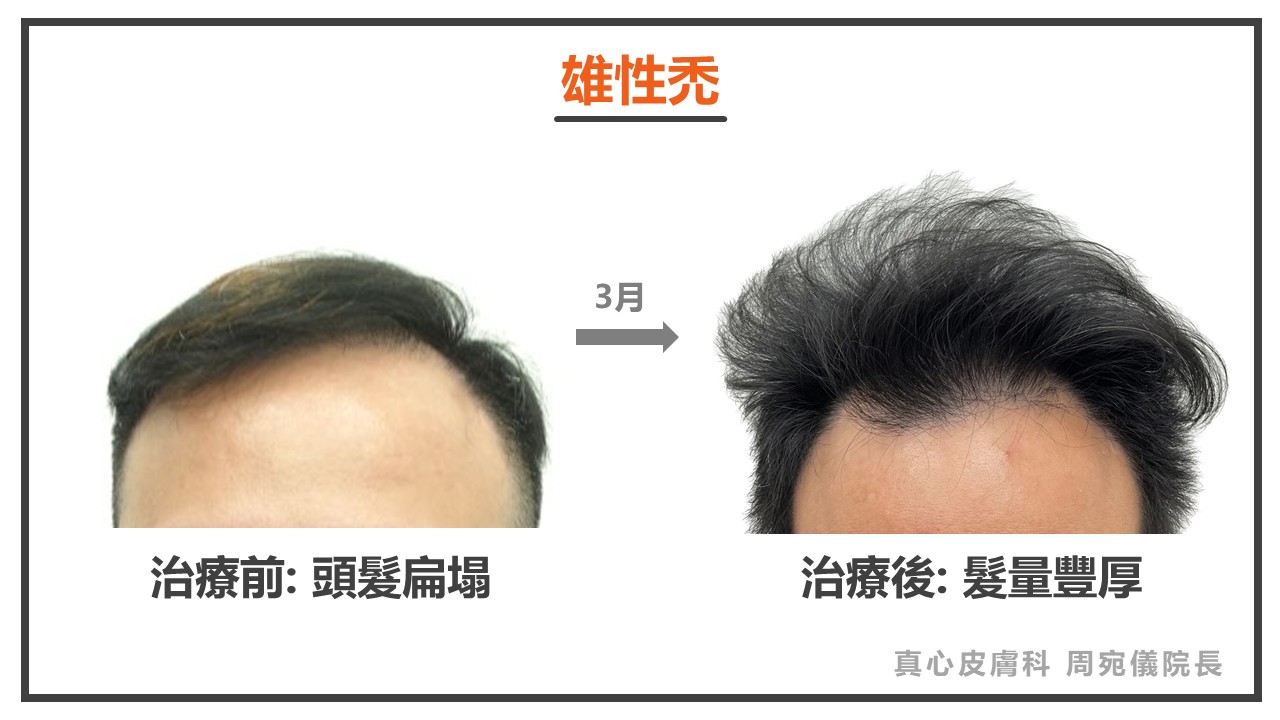 落髮