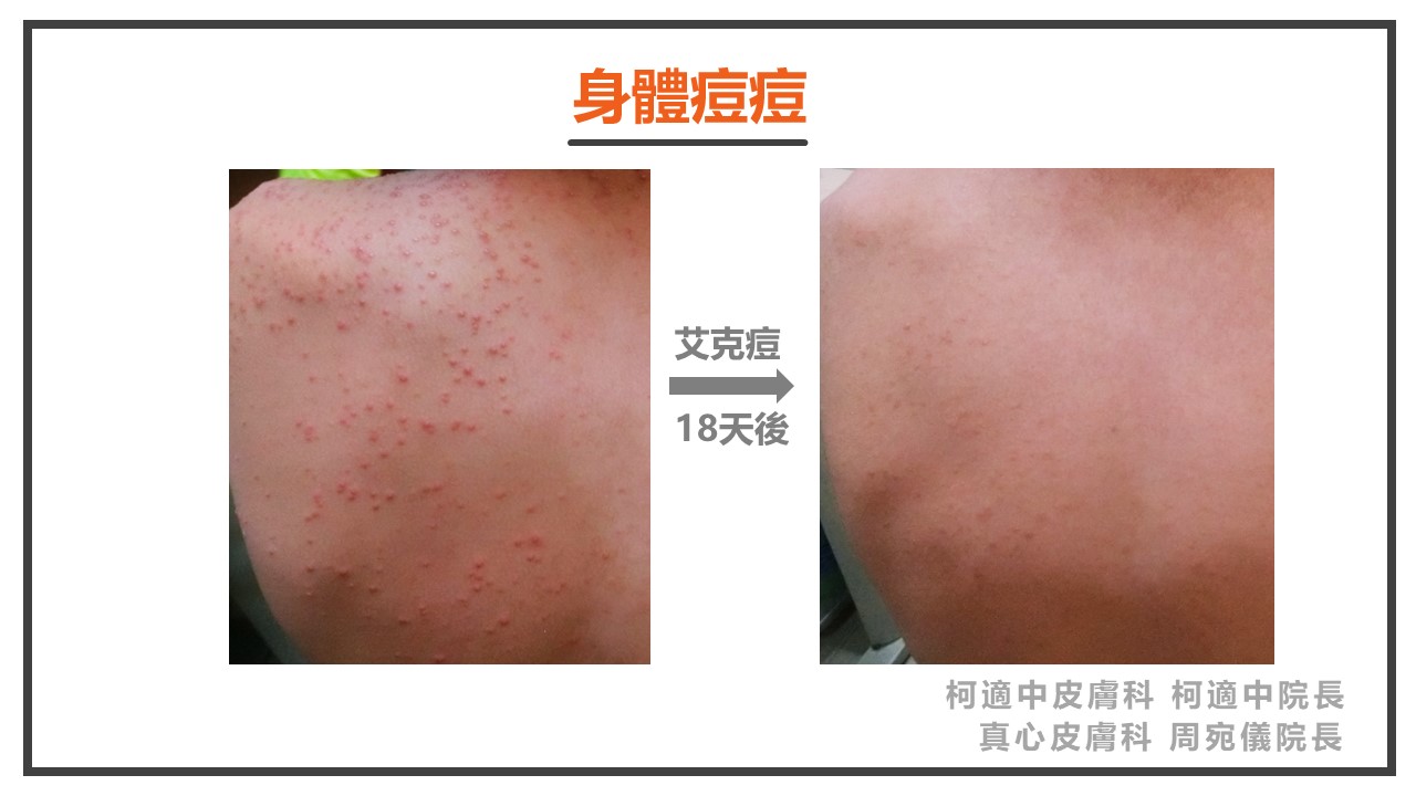 身體痘痘