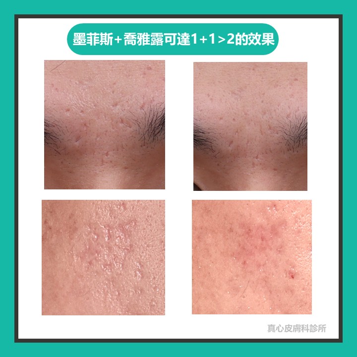 凹痘疤