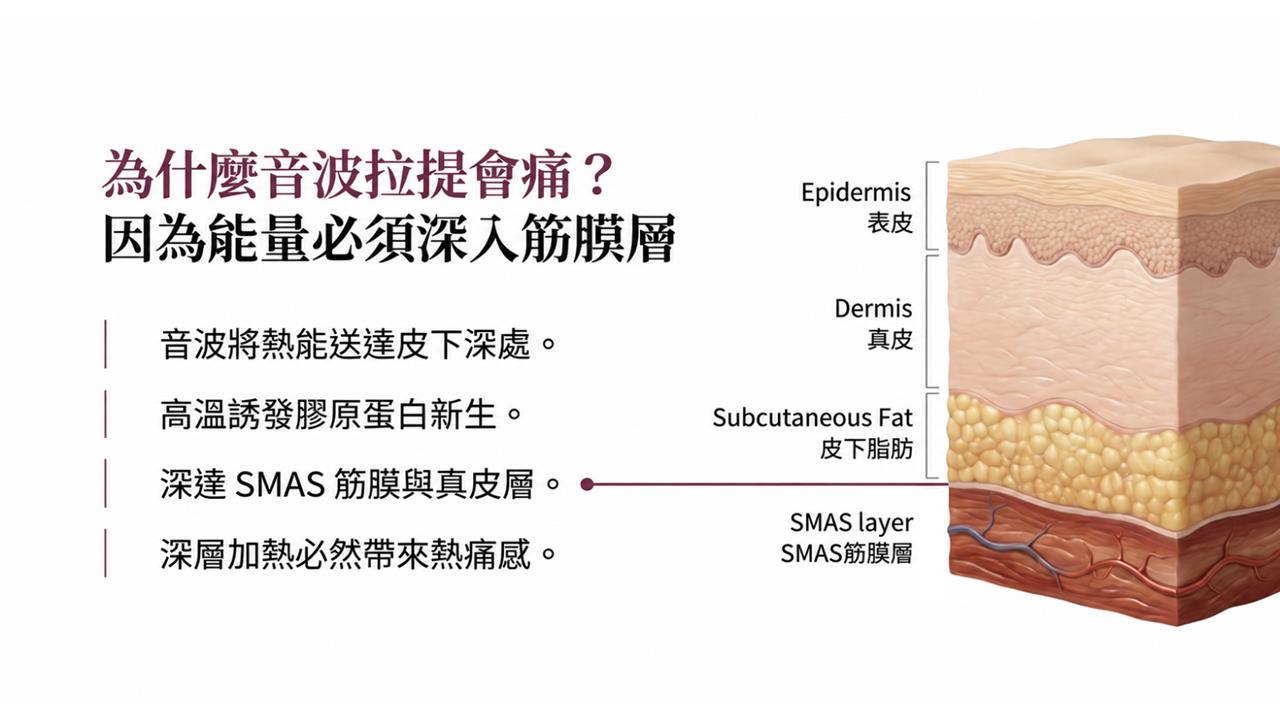 為什麼音波拉提會痛：能量必須深入 SMAS 筋膜層