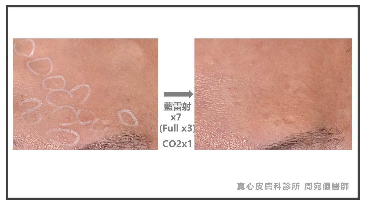 藍雷射