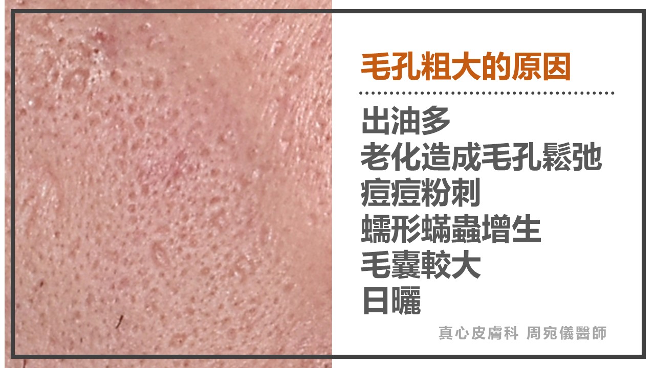 藍雷射痘痘