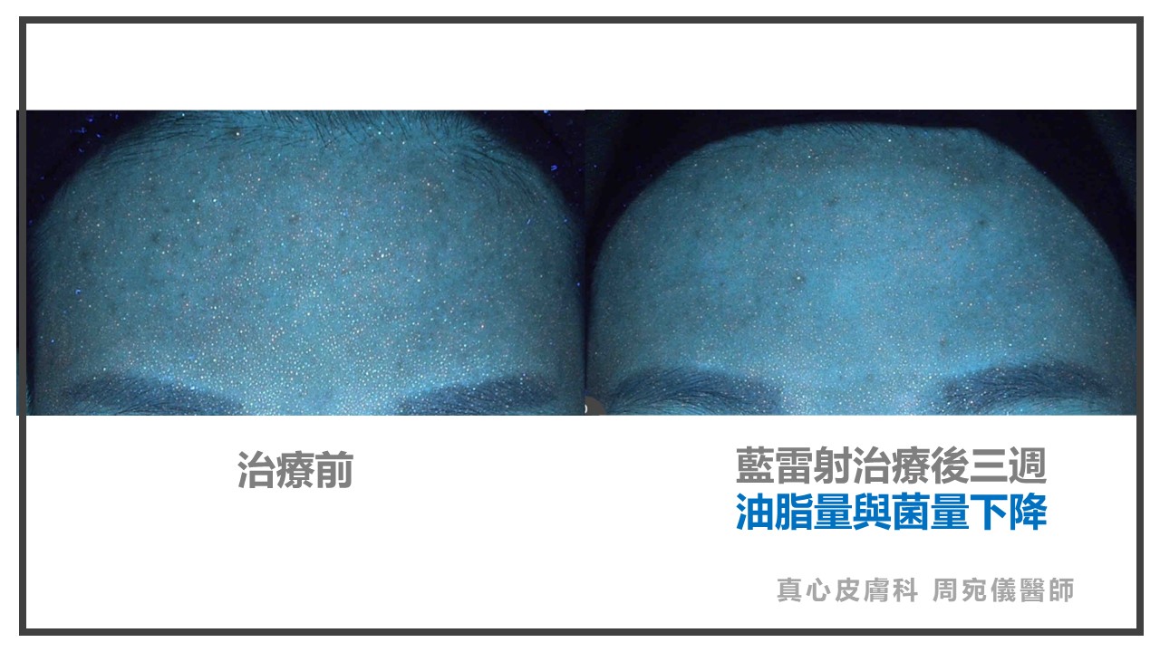 藍雷射痘痘
