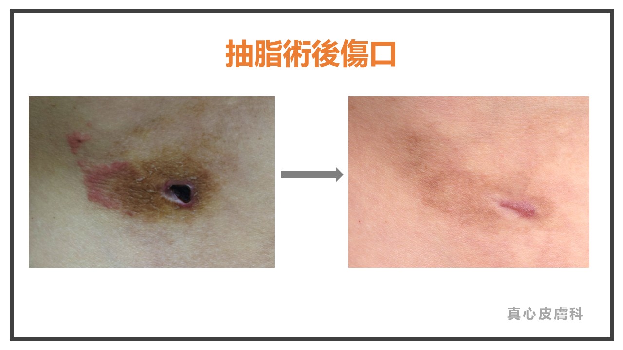 抽脂