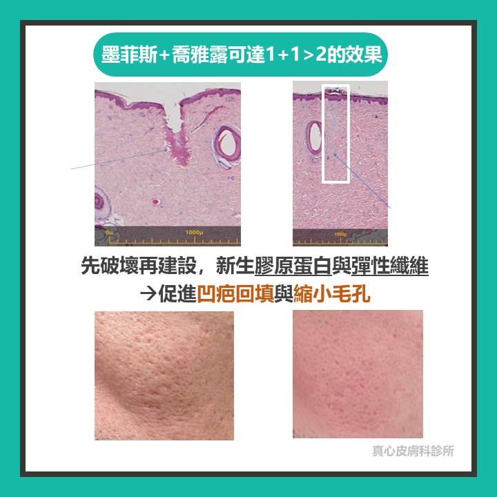 凹痘疤