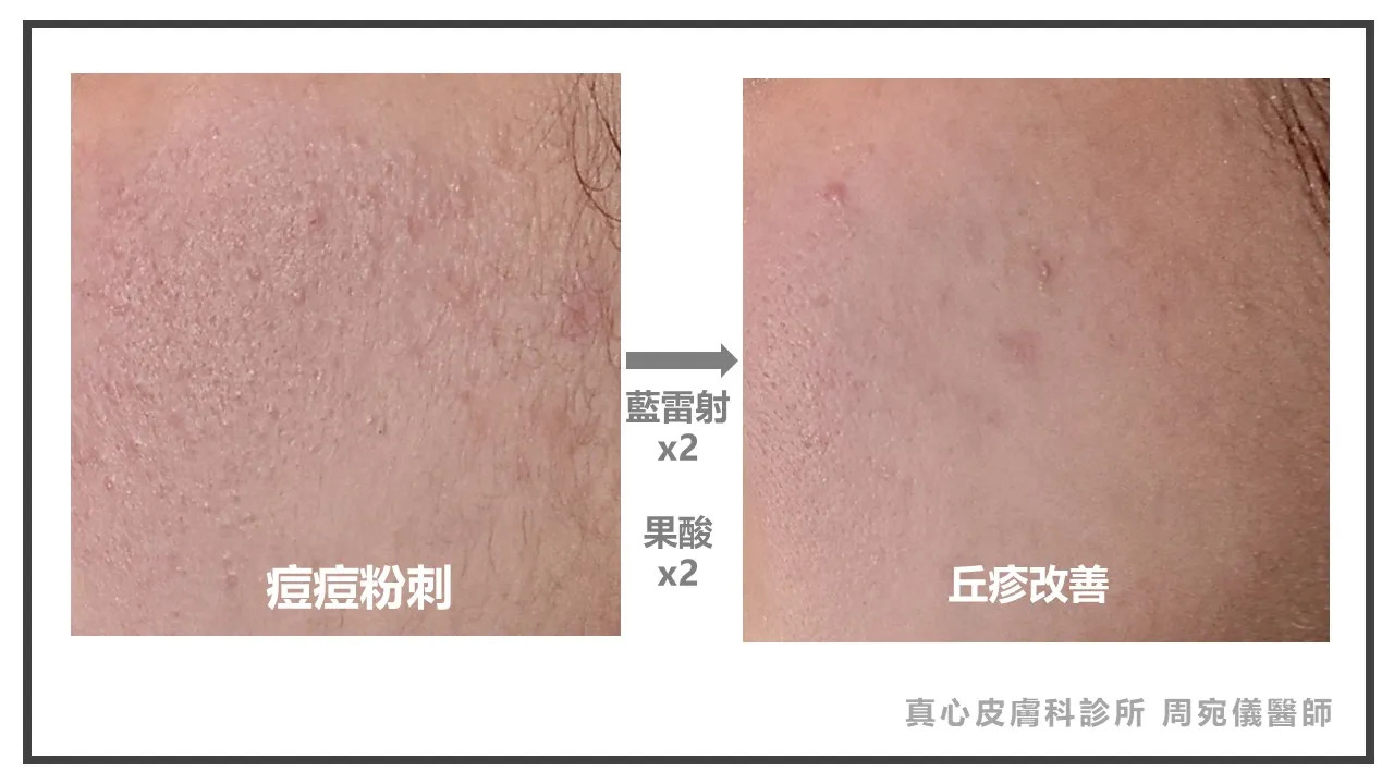 藍雷射效果