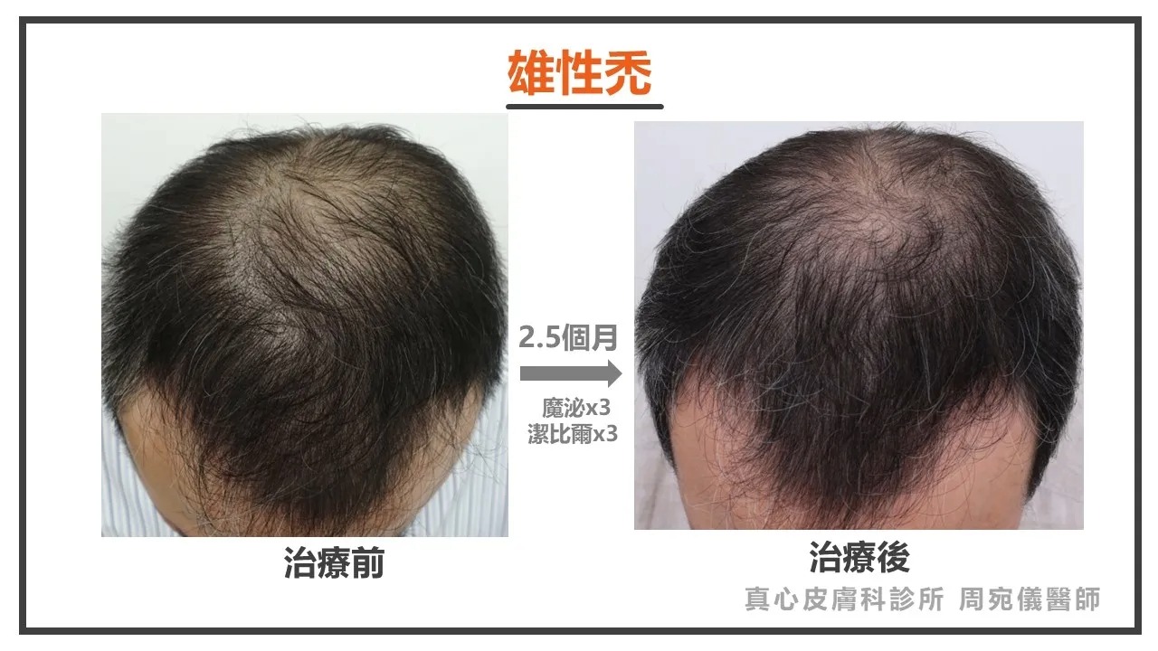雄性禿