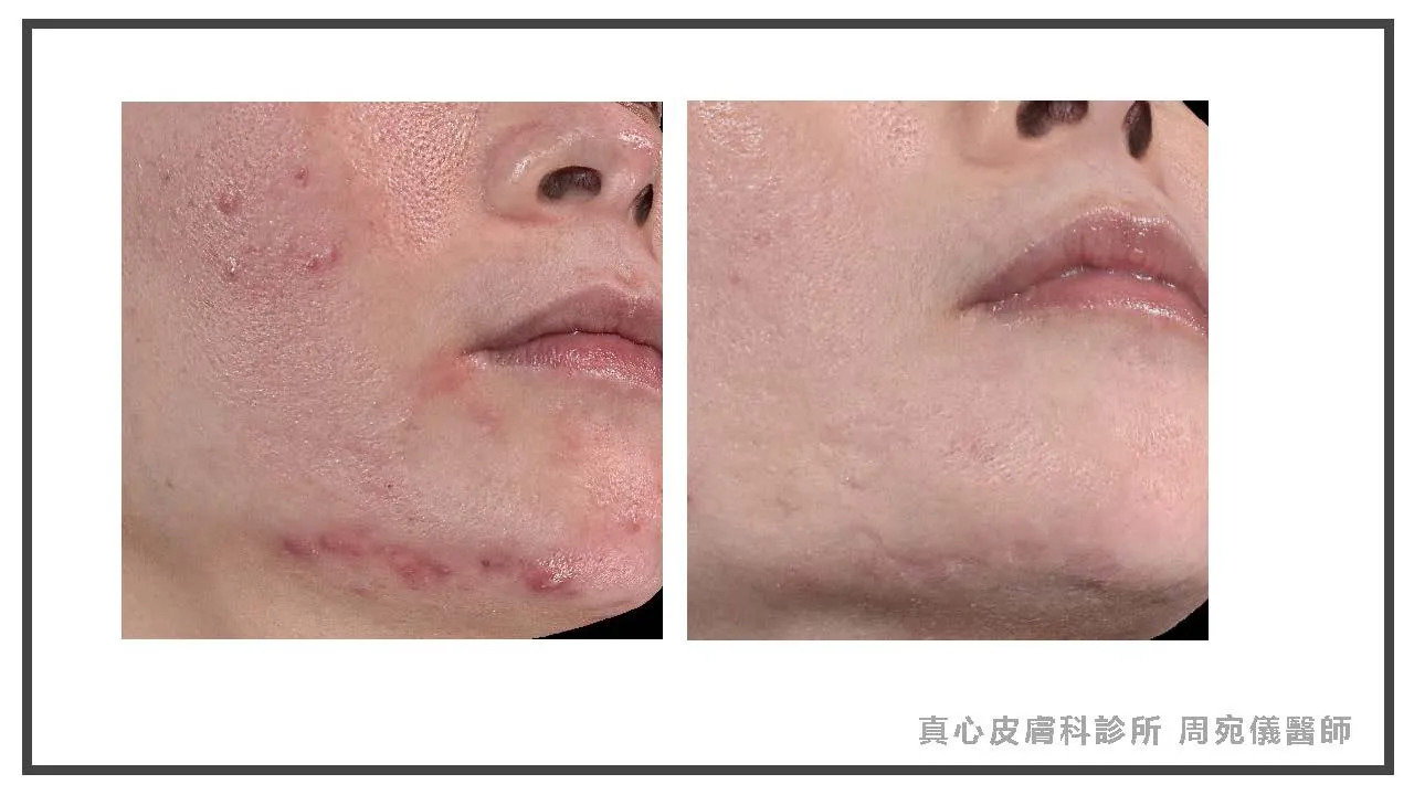 下巴痘痘
