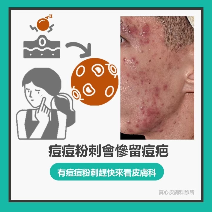 痘疤