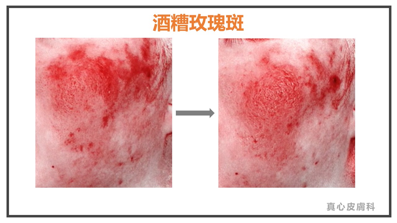 玫瑰斑