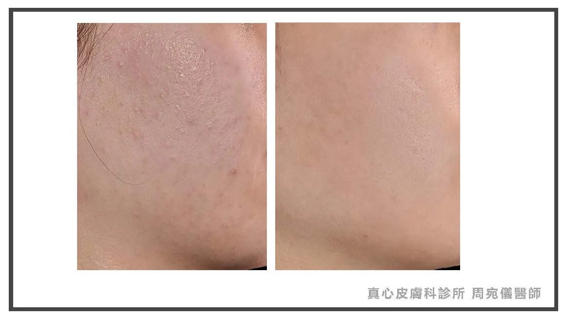 痘痘治療