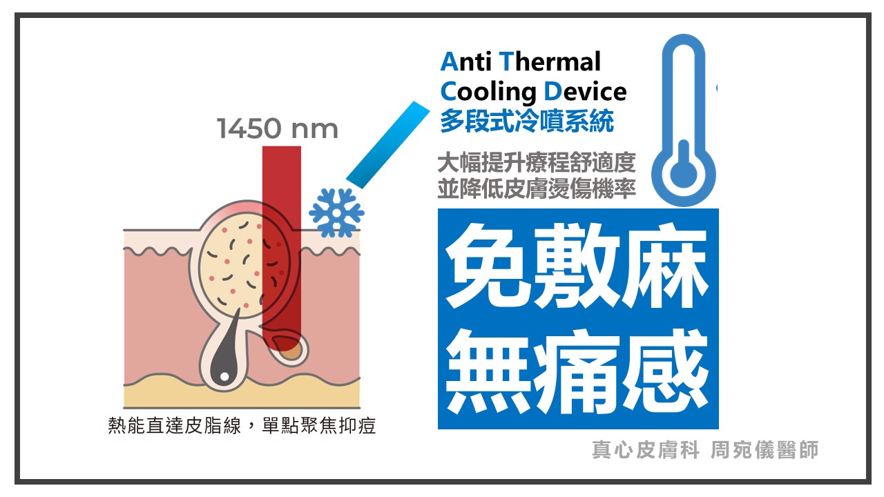 藍雷射功效