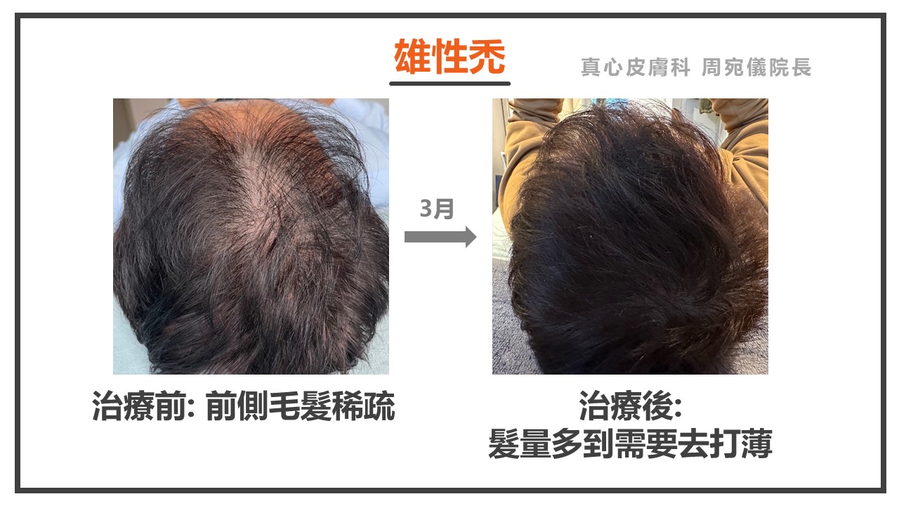 落髮怎麼辦