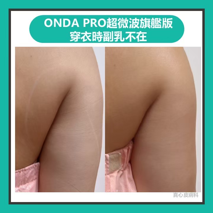 瘦副乳