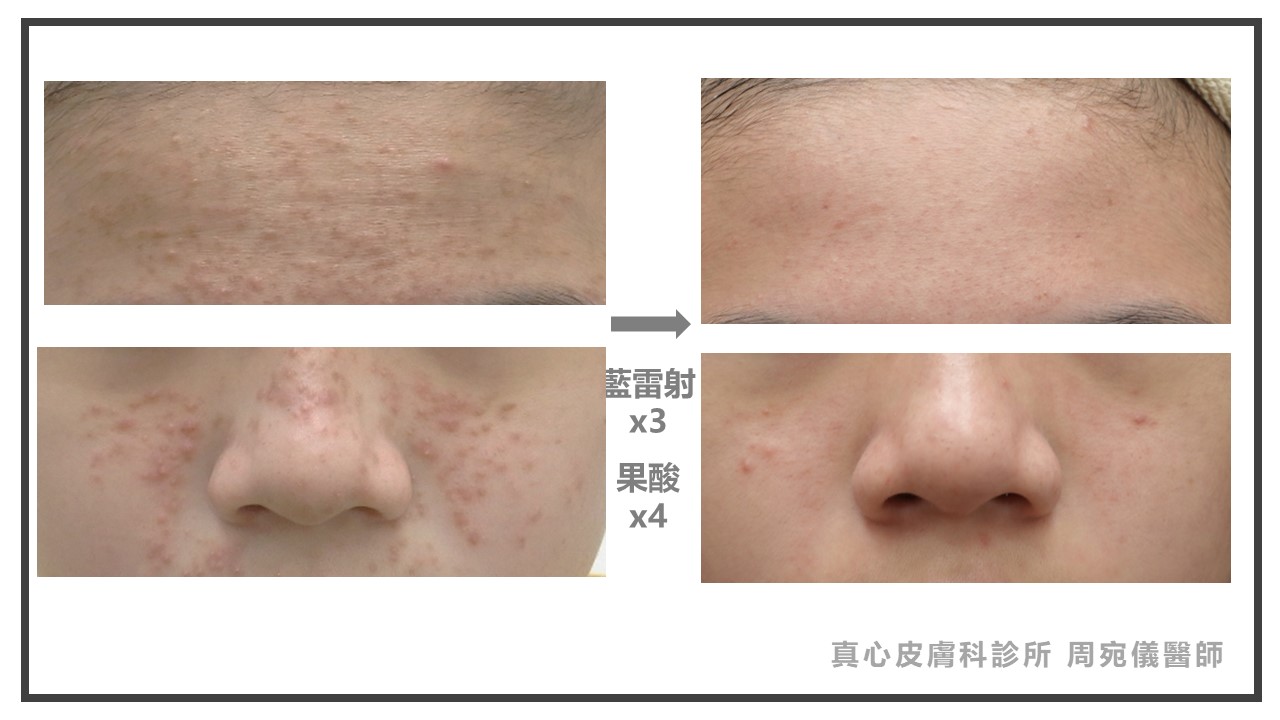 藍雷射兒童痘