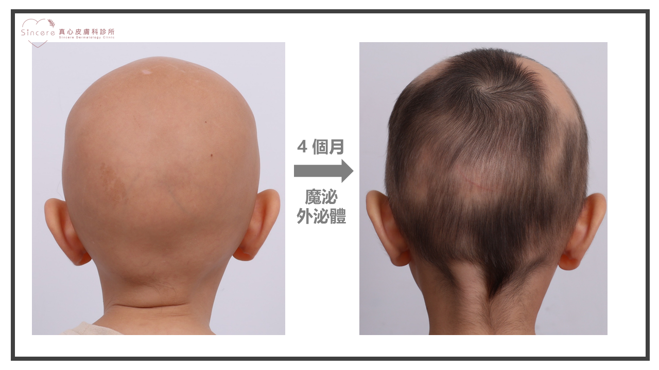 落髮怎麼辦