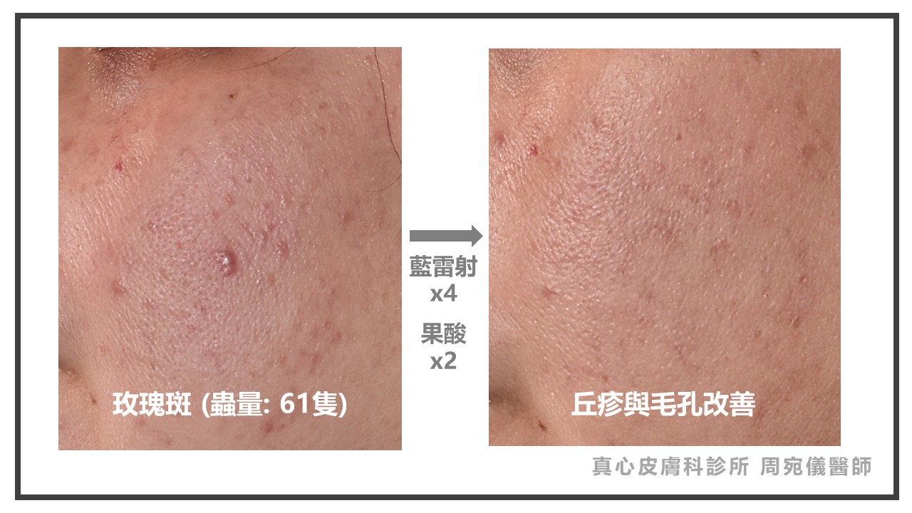 藍雷射玫瑰斑