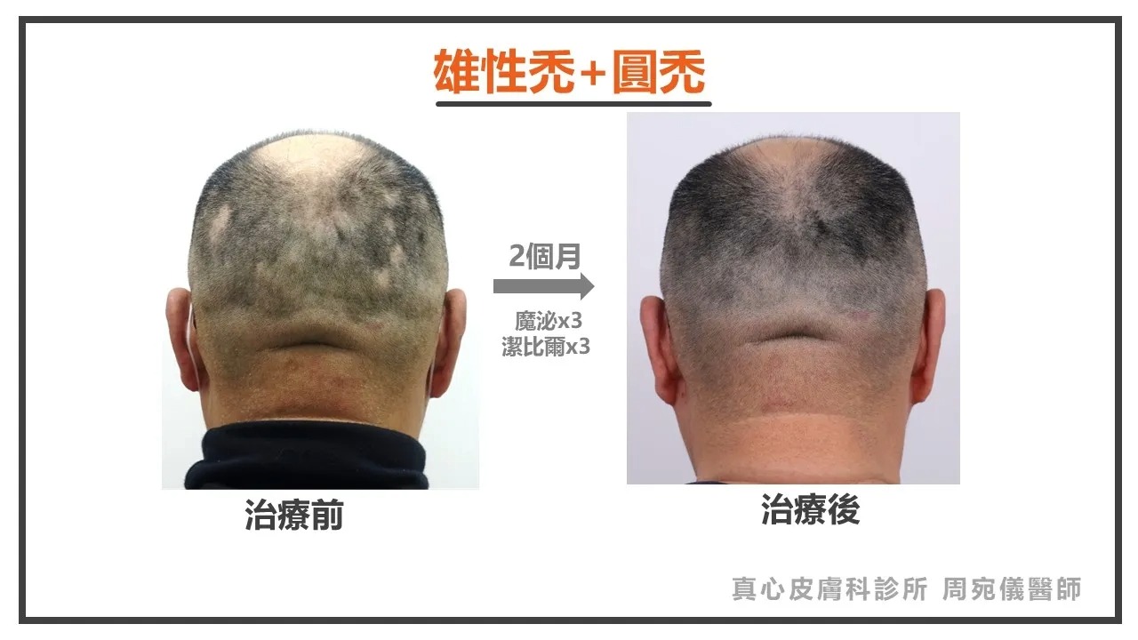 雄性禿