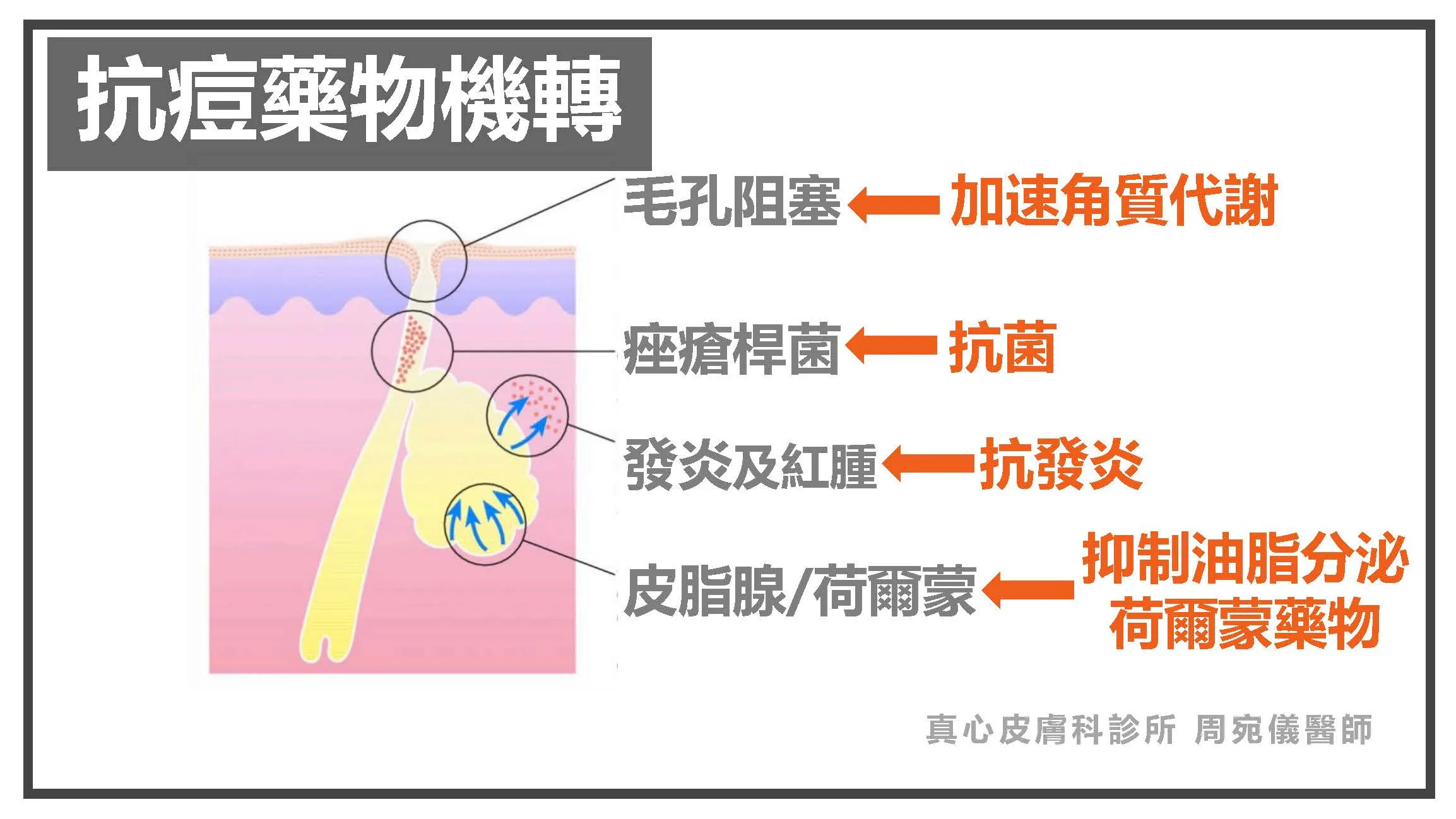 痘痘治療