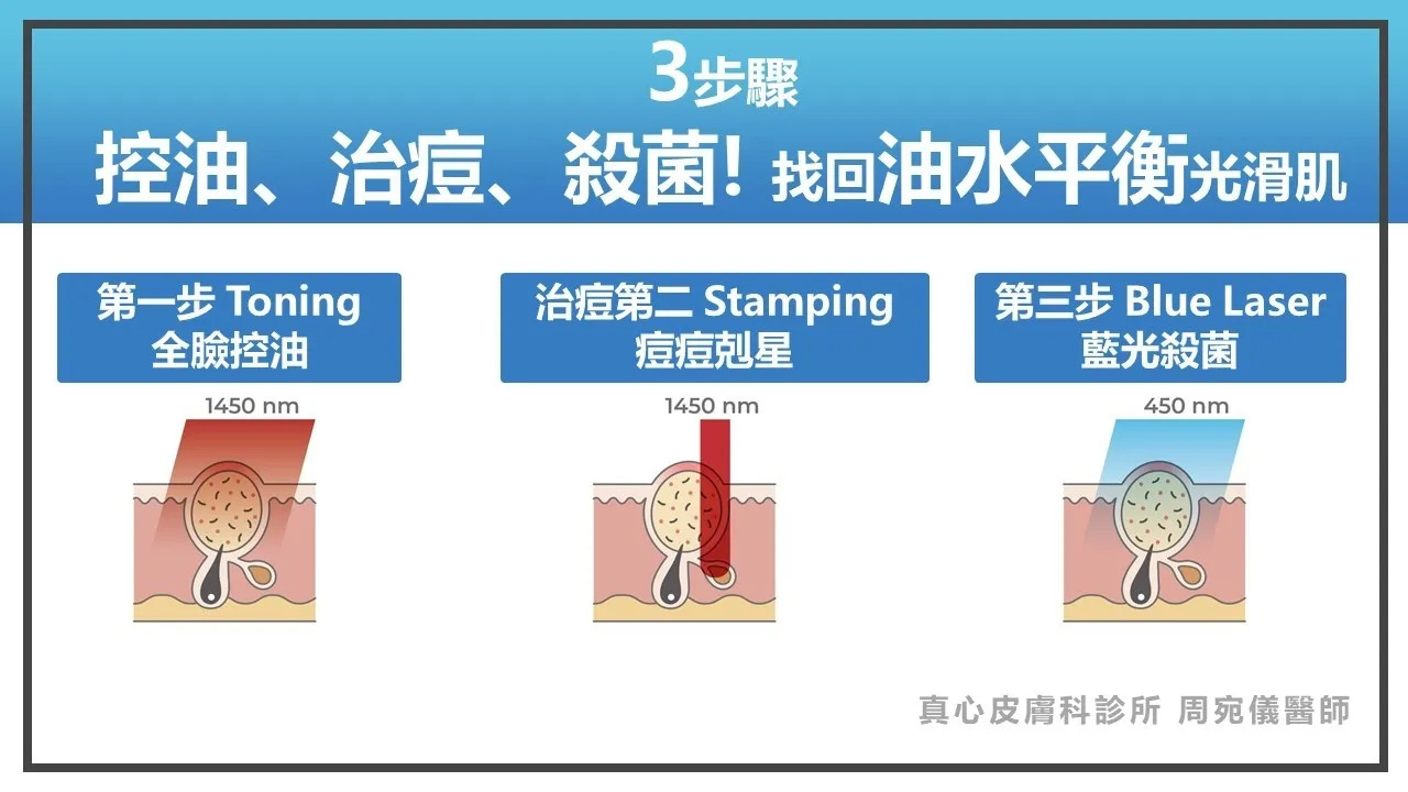 藍雷射效果