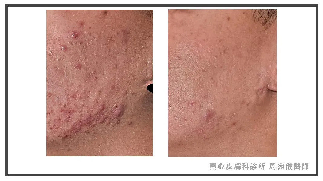 痘痘位置