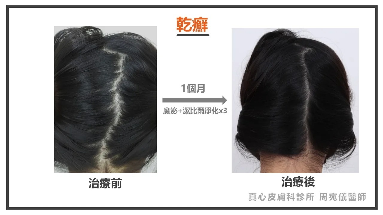 頭皮 乾癬