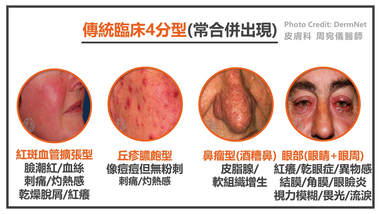 酒糟敏感肌