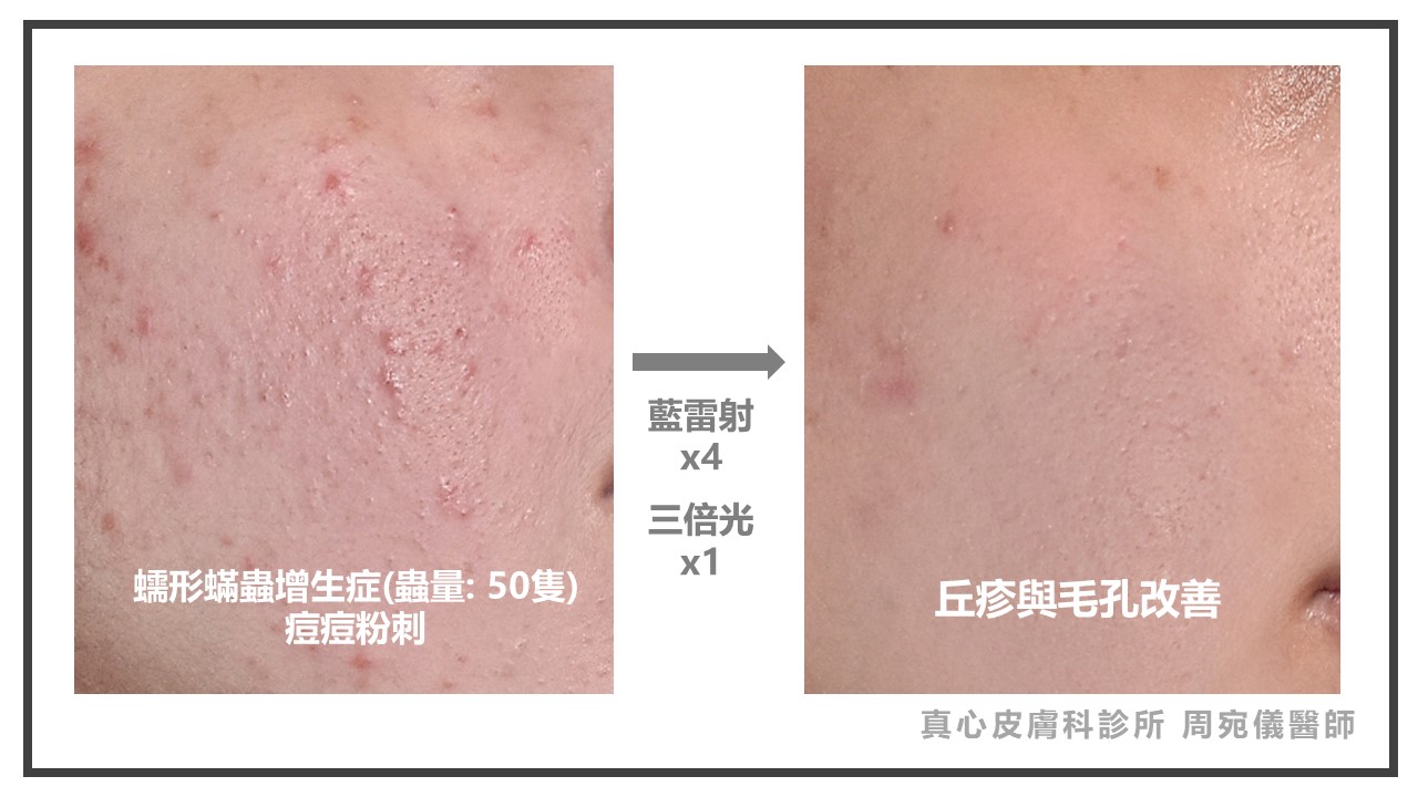 藍雷射玫瑰斑