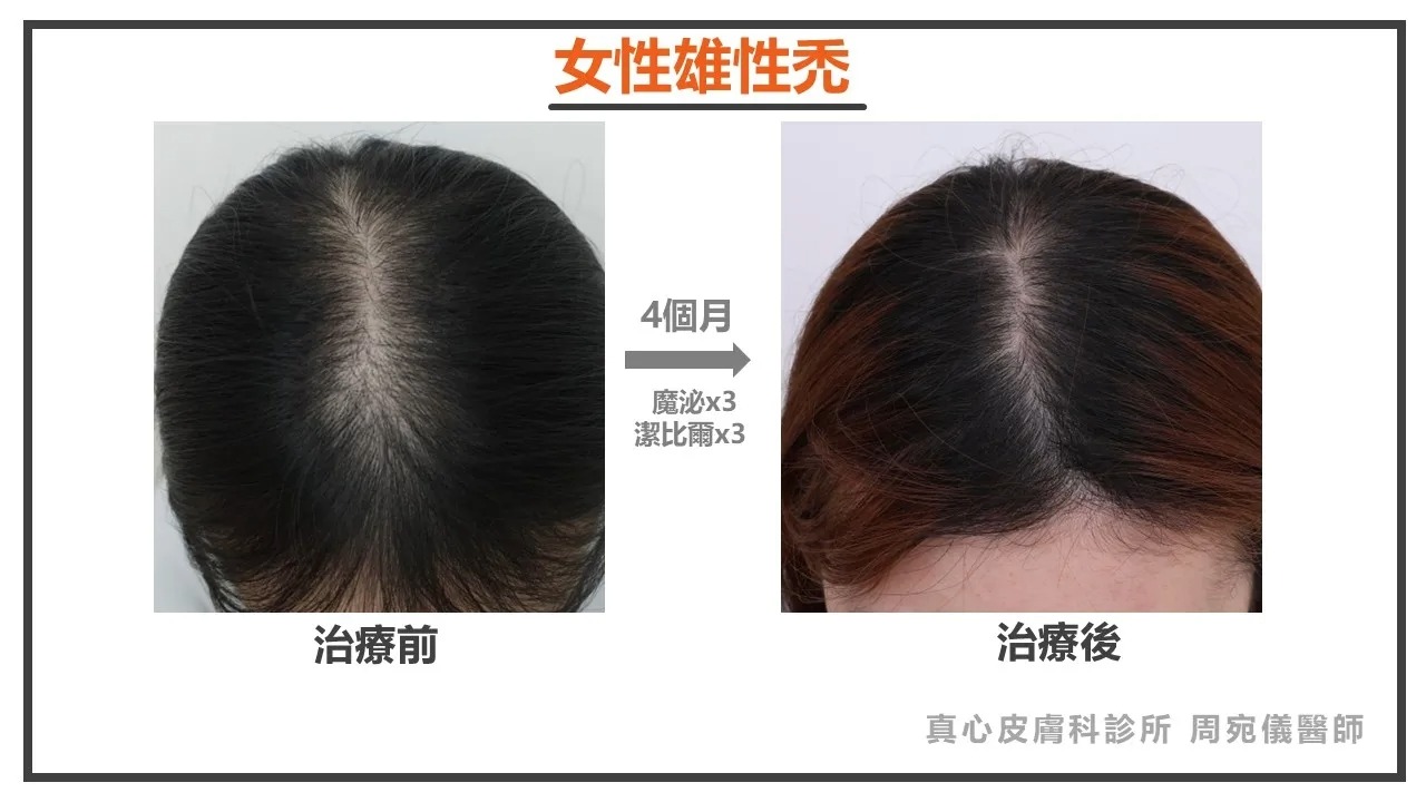 女性雄性禿