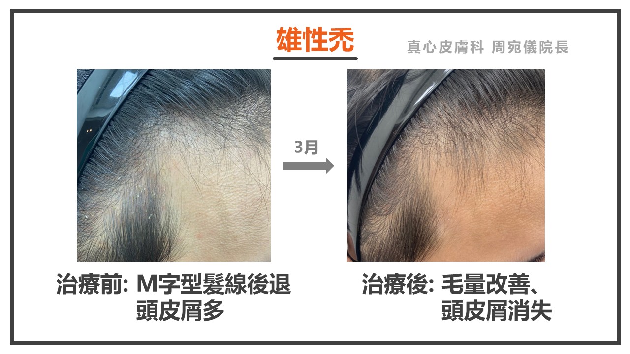落髮