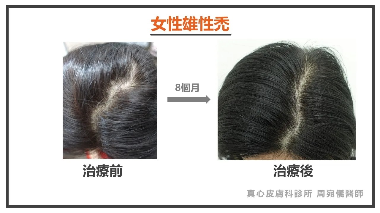 女性雄性禿