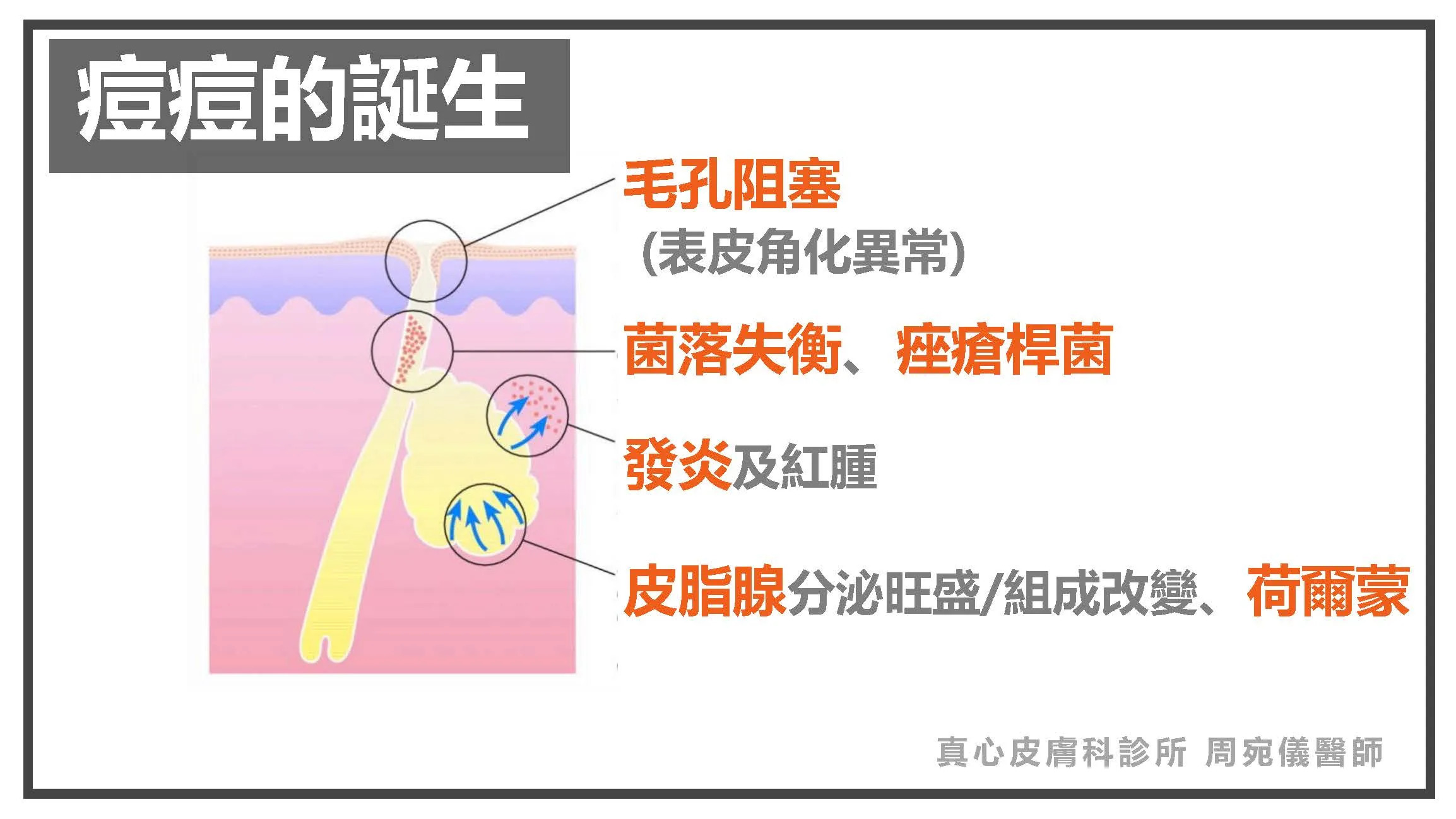 痘痘 形成