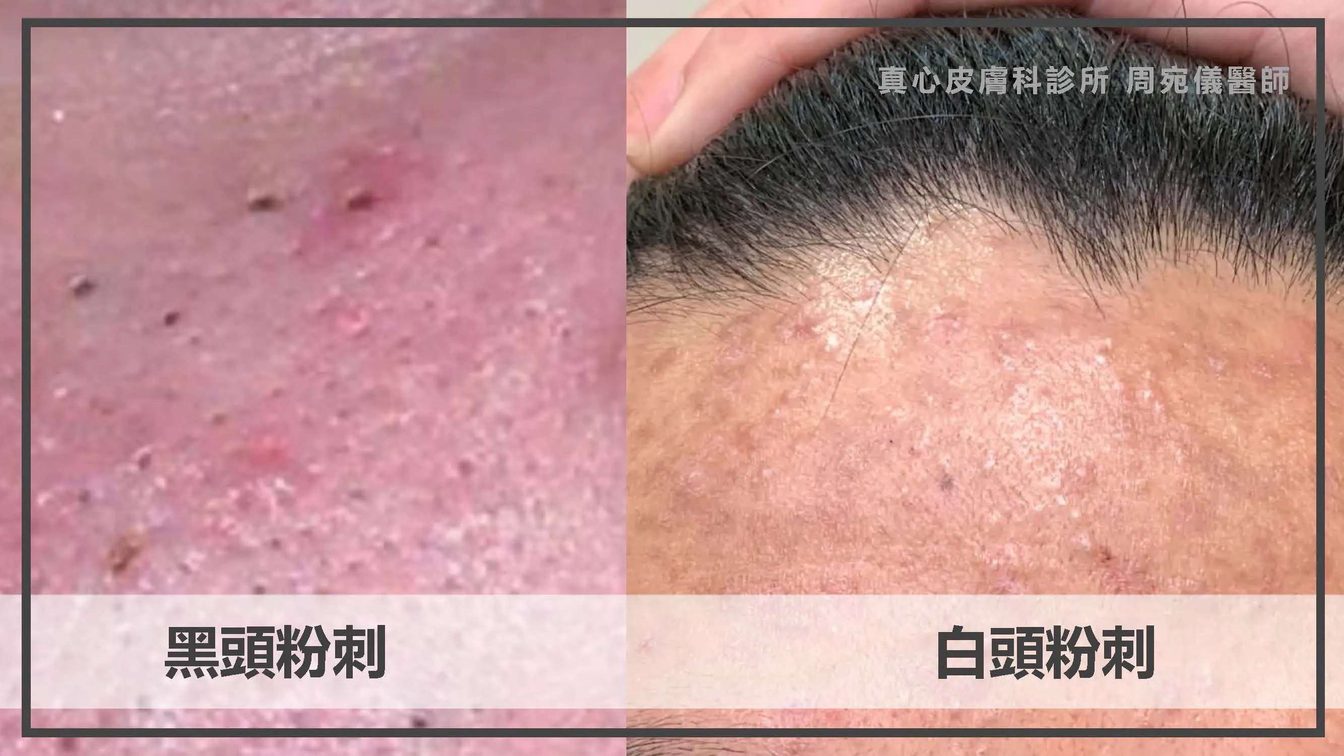 黑頭粉刺