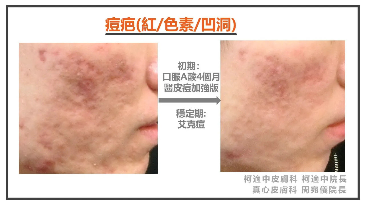 凹疤