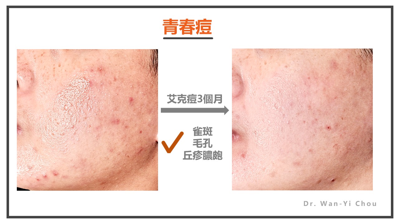 青春痘