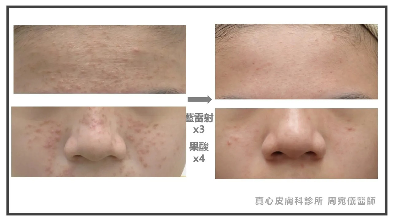 藍雷射效果