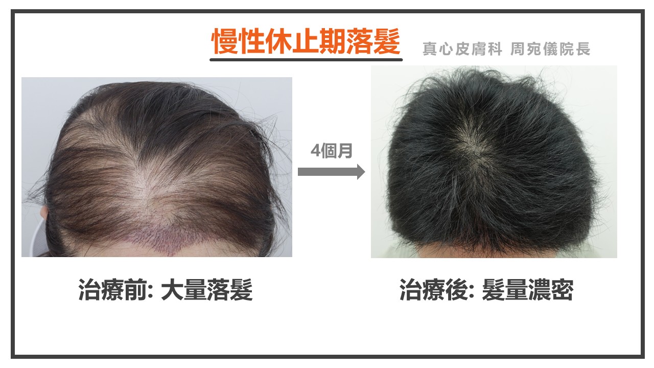 休止期落髮