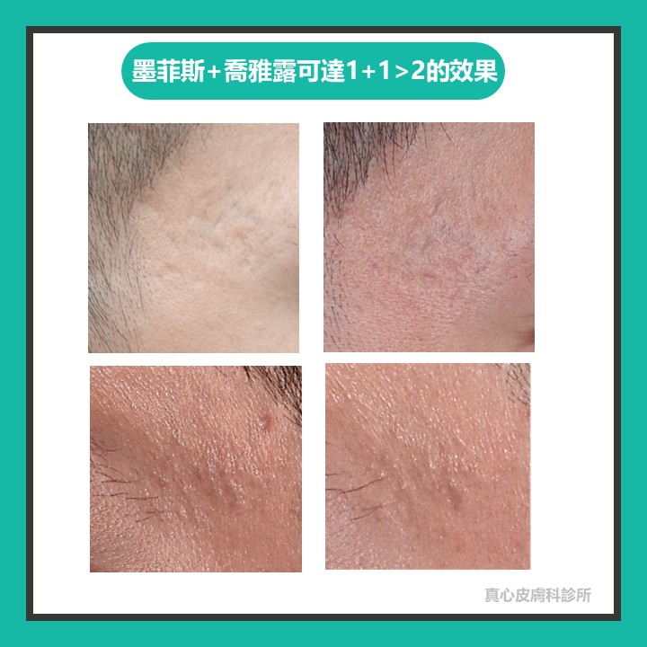 凹洞痘疤