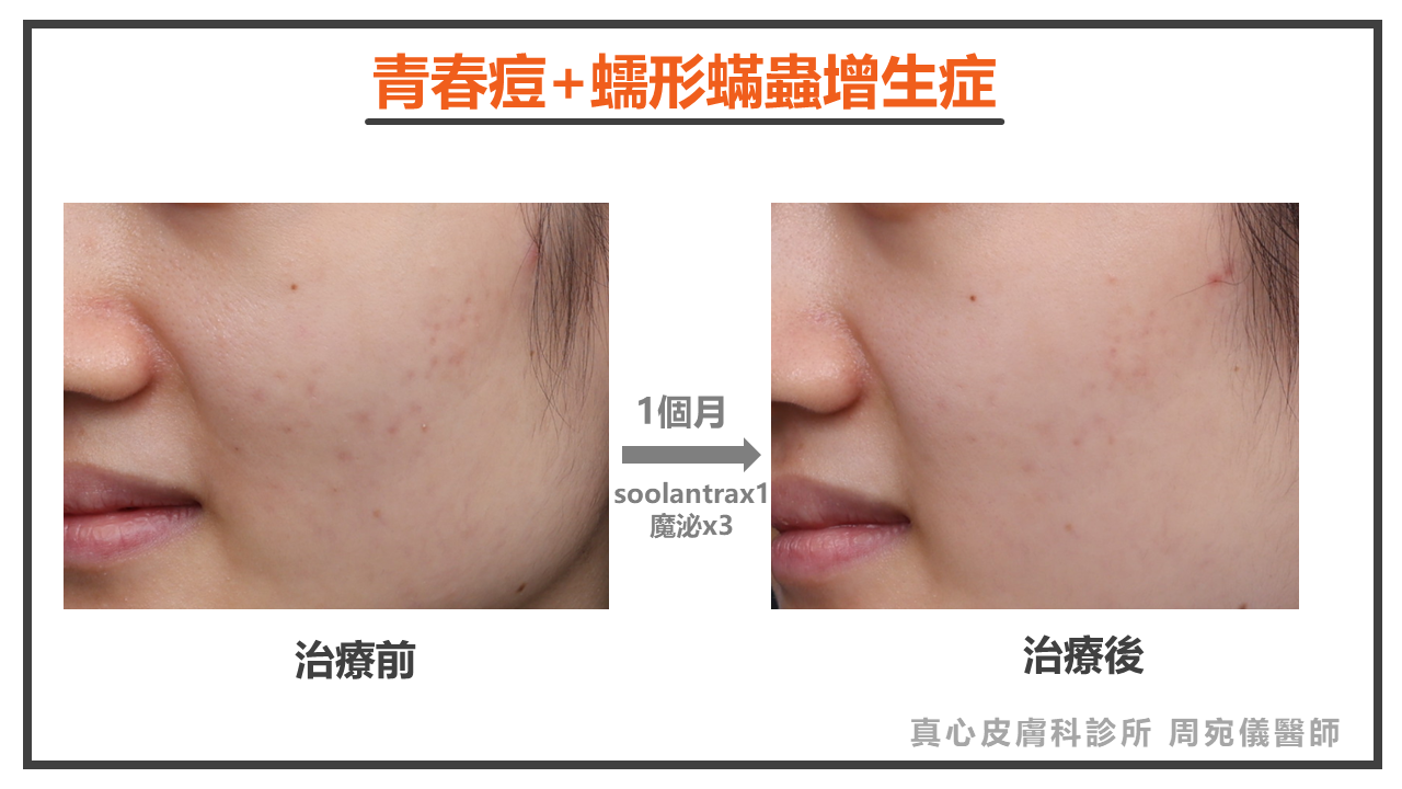 青春痘