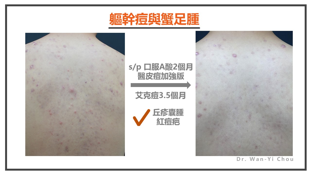 背痘