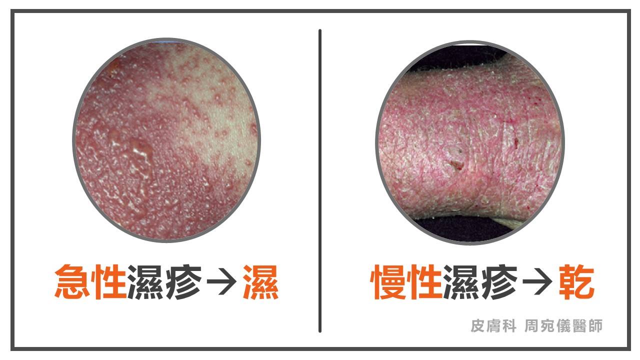 濕疹