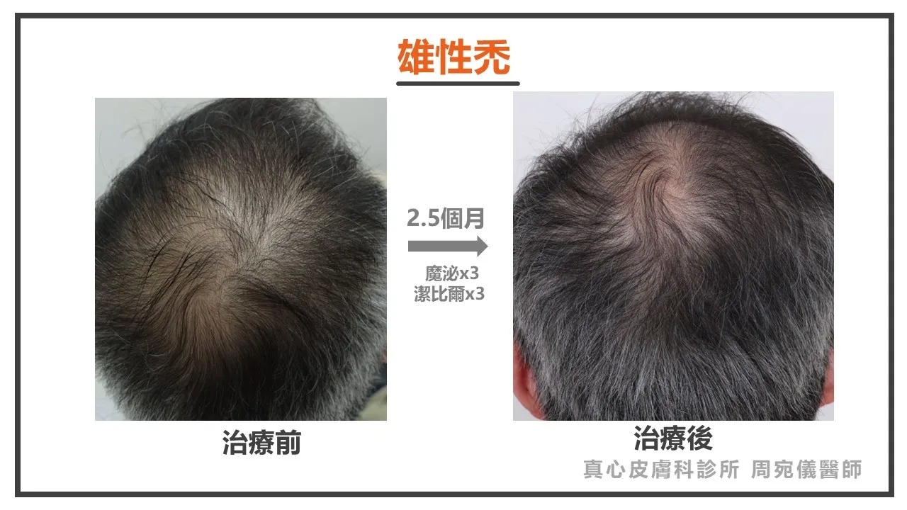 雄性禿