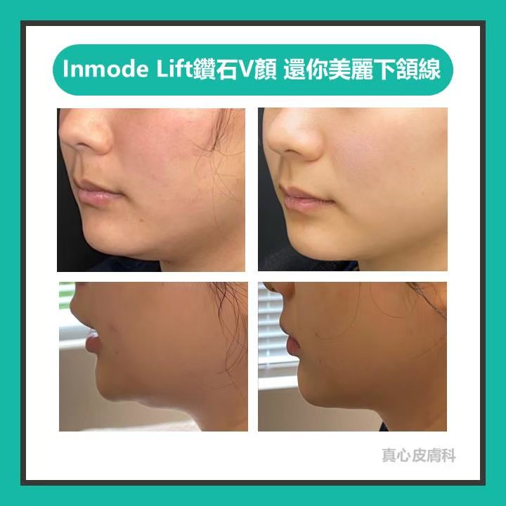 inmode lift