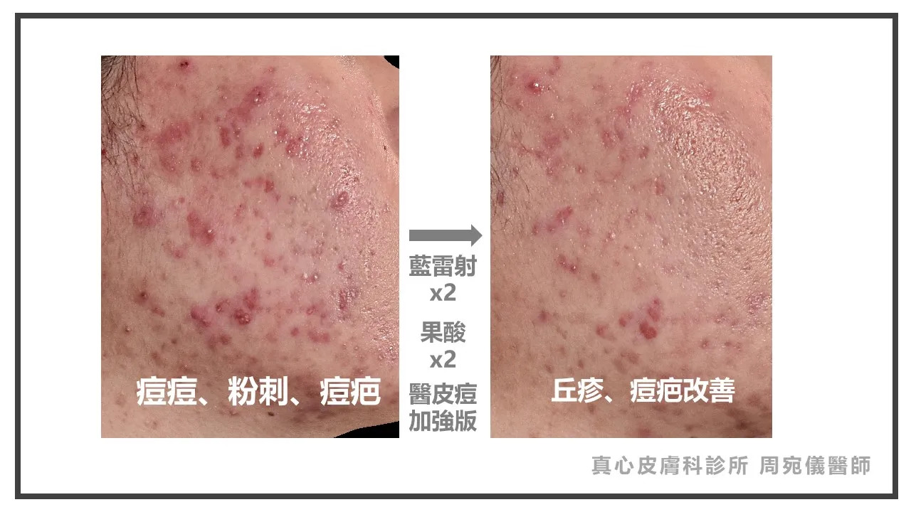 藍雷射效果