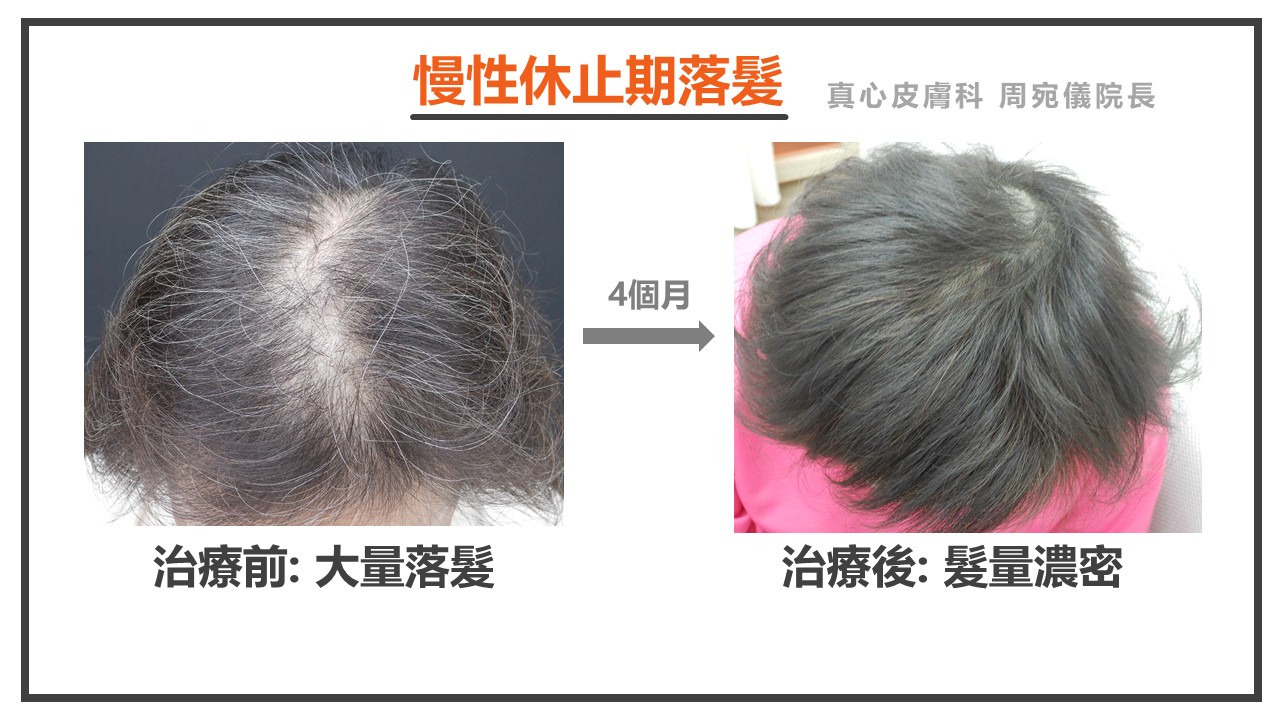 休止期落髮