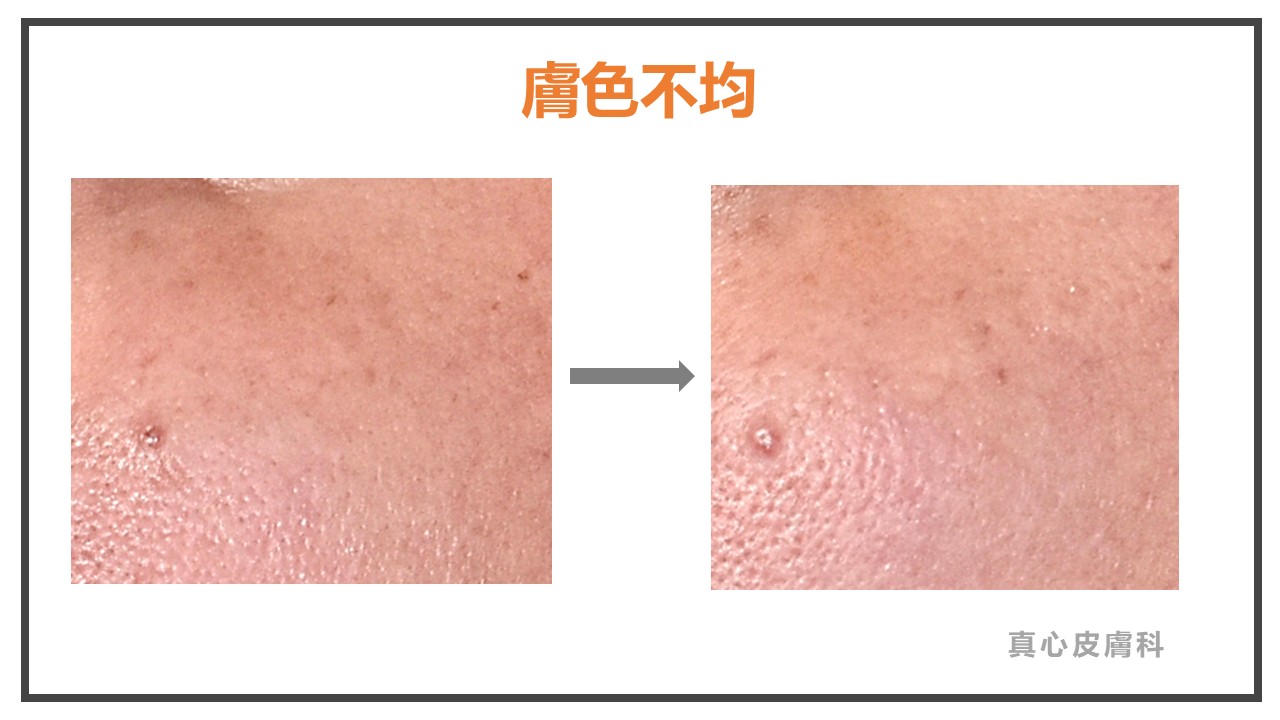 膚色不均 三倍光